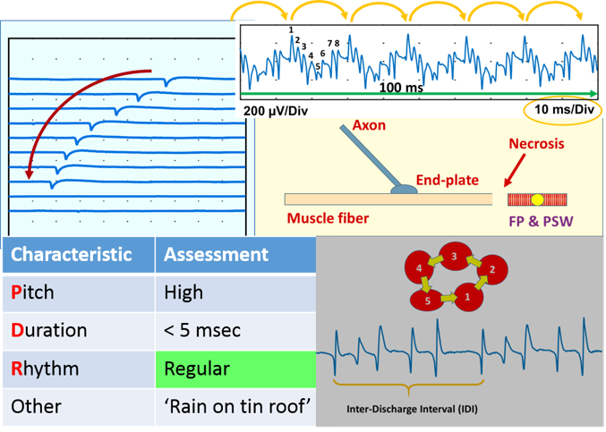 Insertional and Spontaneous Activity